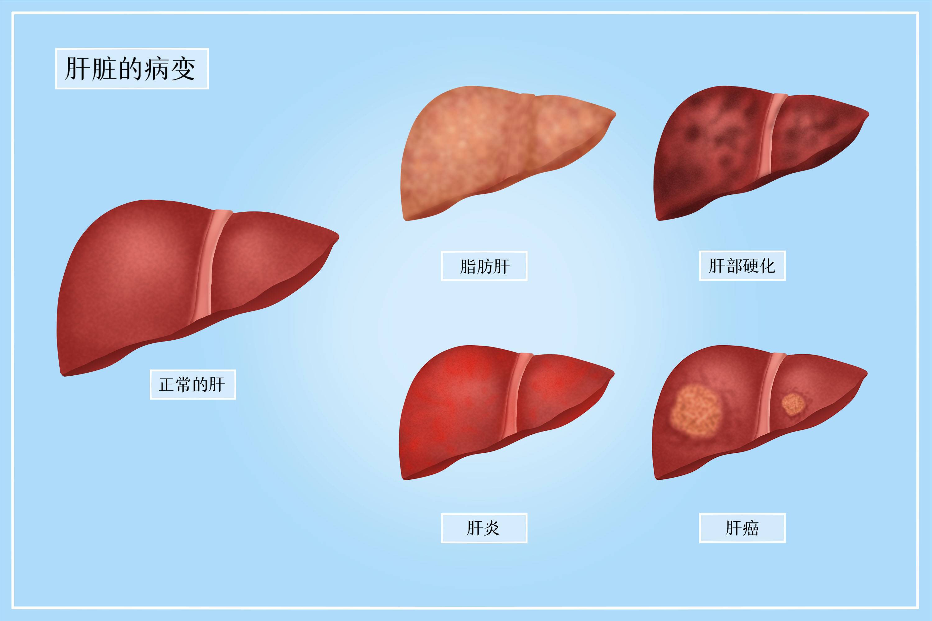 摄图网_401948450_肝脏的病变医疗插画（企业商用）(1)